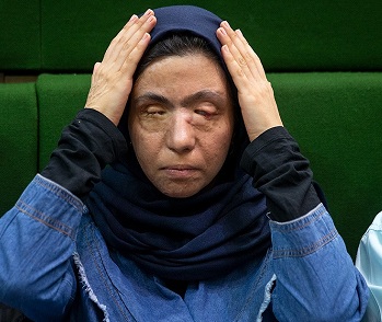 مسئولیت اجتماعی یک قربانی اسیدپاشی در روزهای کرونایی